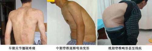 郑州痛风风湿病医院强直性脊柱炎患者脊椎弯曲 .jpg