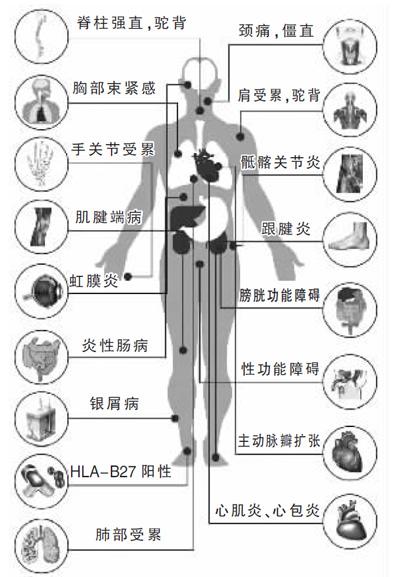 郑州痛风风湿病医院强直性脊柱炎的危害可累及全身.jpg
