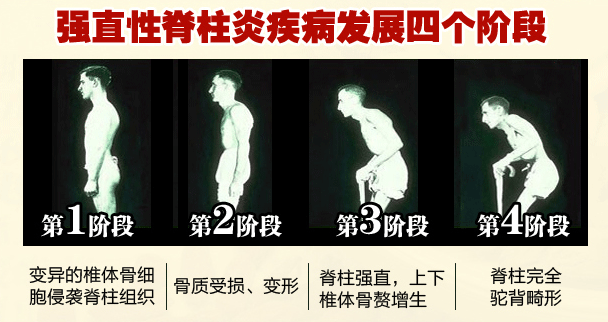 强直性脊柱炎病情发展配图.jpg