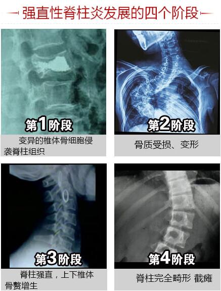 强直性脊柱炎发展的四个阶段.jpg