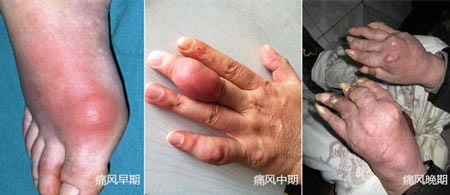 郑州痛风风湿病医院痛风诱发后不同时期的症状.jpg