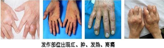 郑州痛风风湿病医院手部痛风症状.jpg